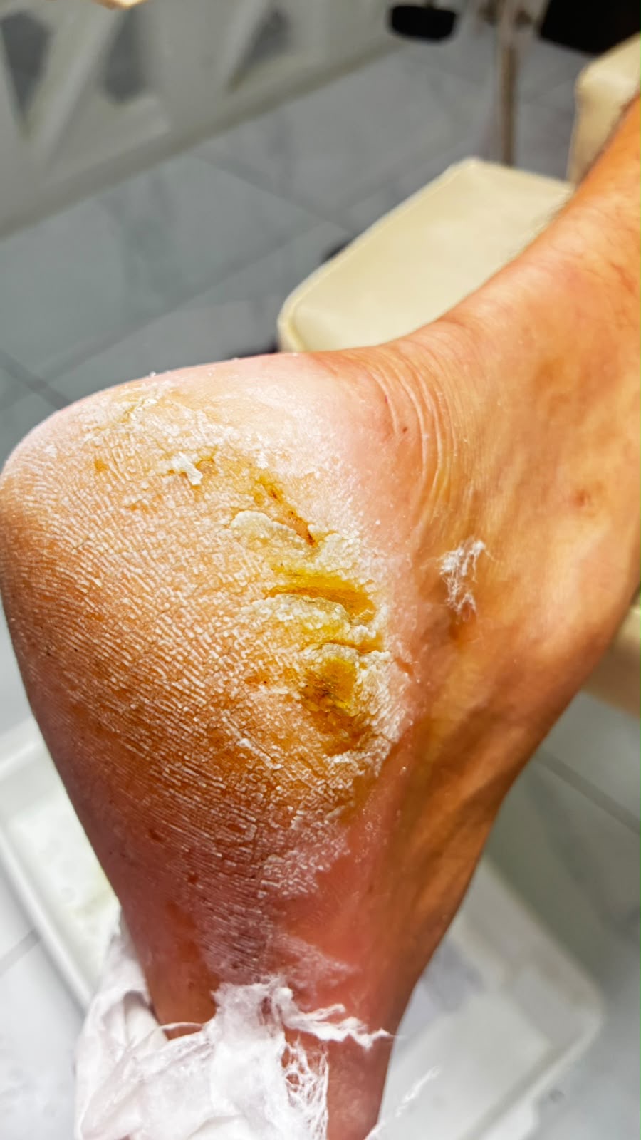 Detalhe do cuidado da pele dos pés com fissuras e ressecamento