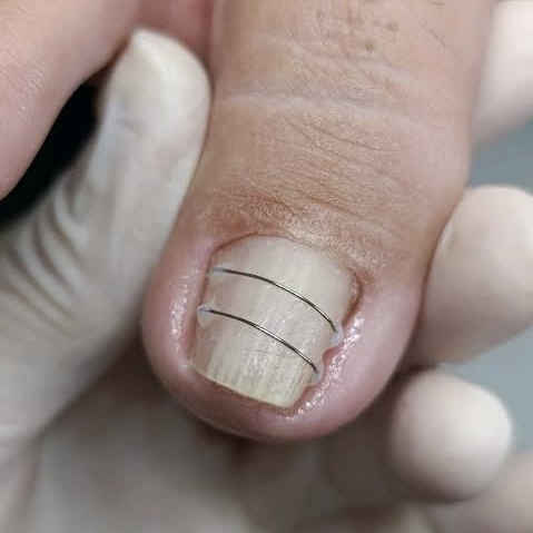 Detalhe de unha com órtese ungueal para acompanhamento da curvatura