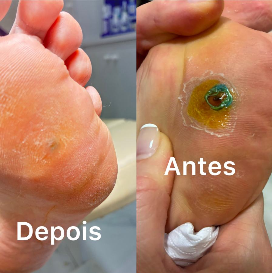 Comparação real de cuidado de calosidade, depois à esquerda e antes à direita